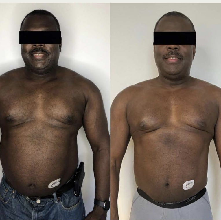 glp 1 before and after men GLP-1 For Weight Loss